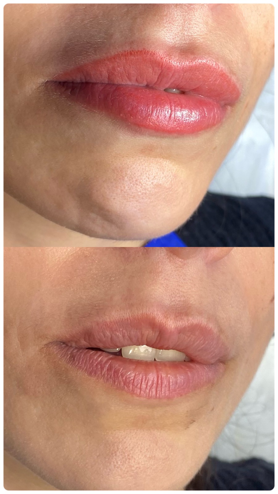 Permanent Makeup Lip Pigmentation