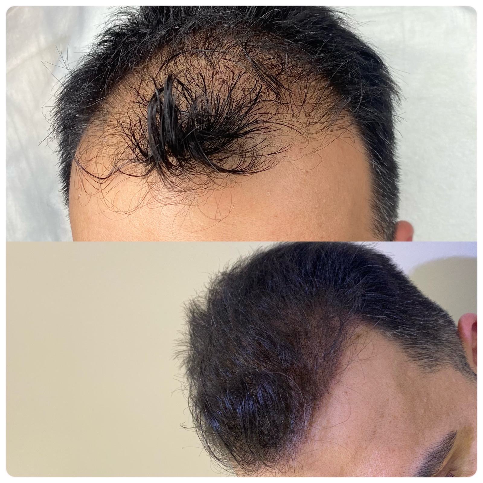 Scalp Micropigmentation