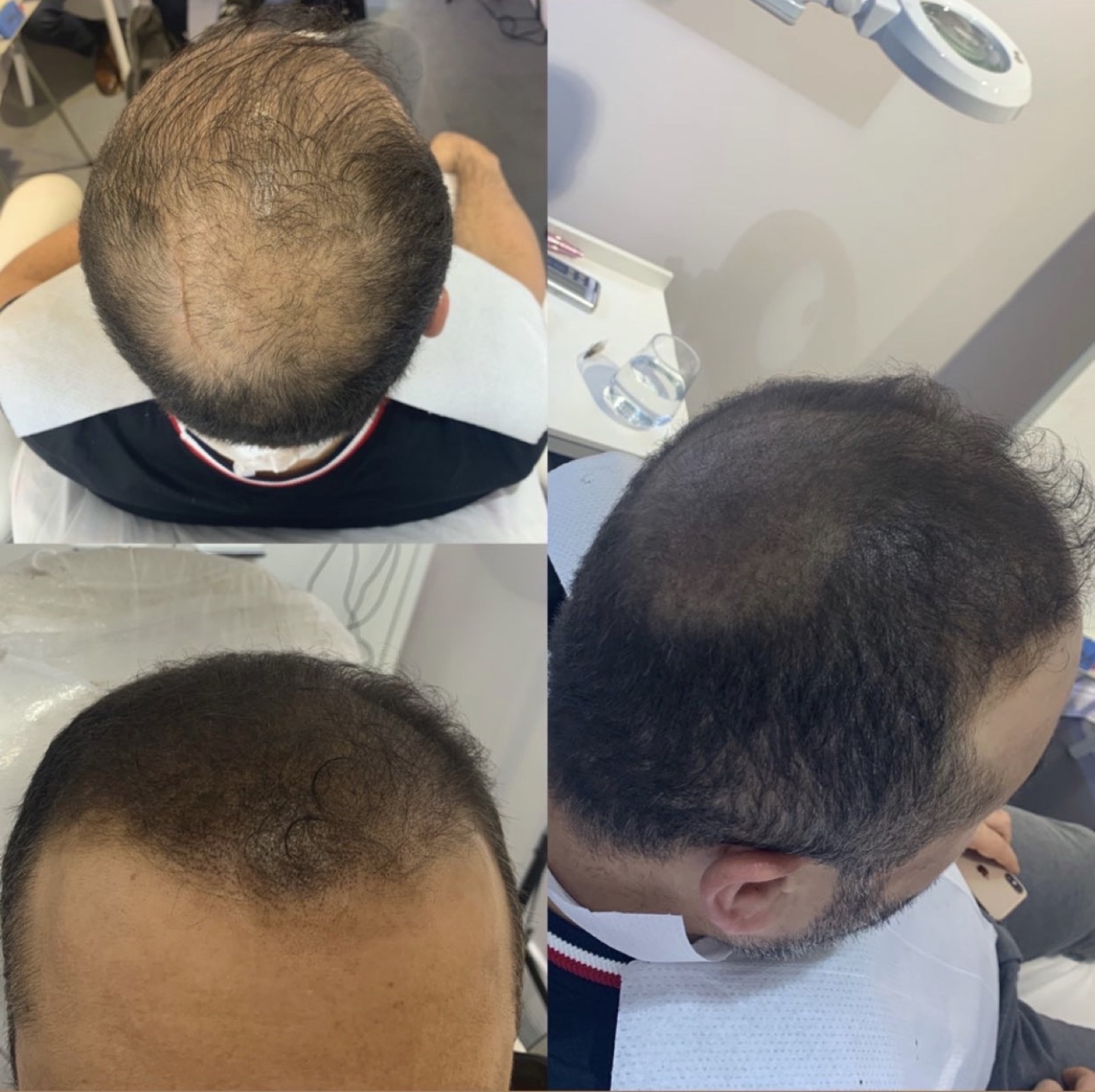 Scalp Micropigmentation